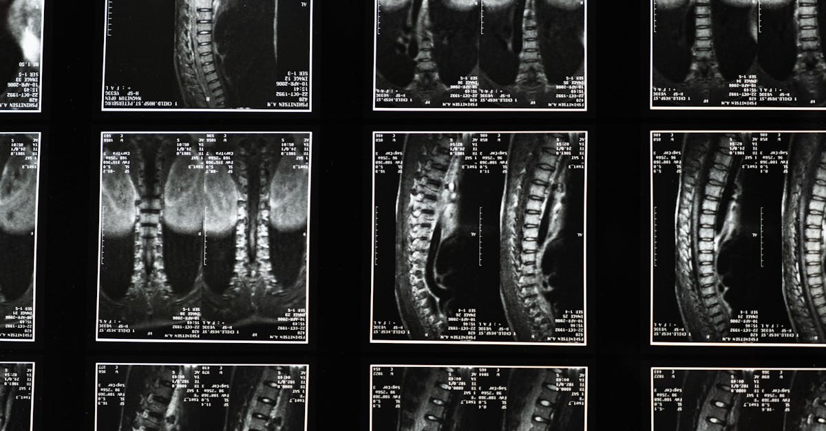 discover comprehensive insights about scoliosis, its causes, symptoms, and treatment options. empower yourself with knowledge to manage and understand this spinal condition better.