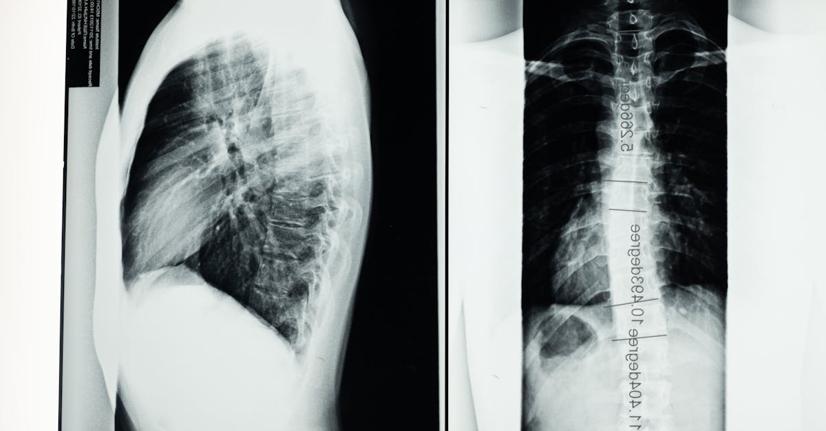 discover what scoliosis is, its causes, symptoms, and treatment options. learn how to manage and live with this spinal condition effectively.