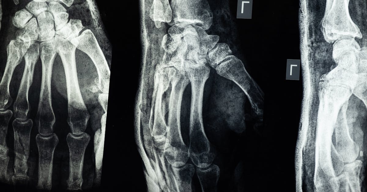 explore the causes, symptoms, and treatment options for brachial plexus injuries. learn how to effectively manage and recover from this complex condition affecting the nerves in your shoulder and arm.
