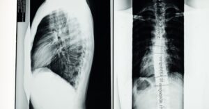 discover comprehensive insights into scoliosis, a condition characterized by abnormal curvature of the spine. explore causes, symptoms, diagnosis, and effective treatment options to manage this condition and improve quality of life.